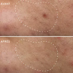 Deep Breakout Liquid Patch Anti-Imperfections