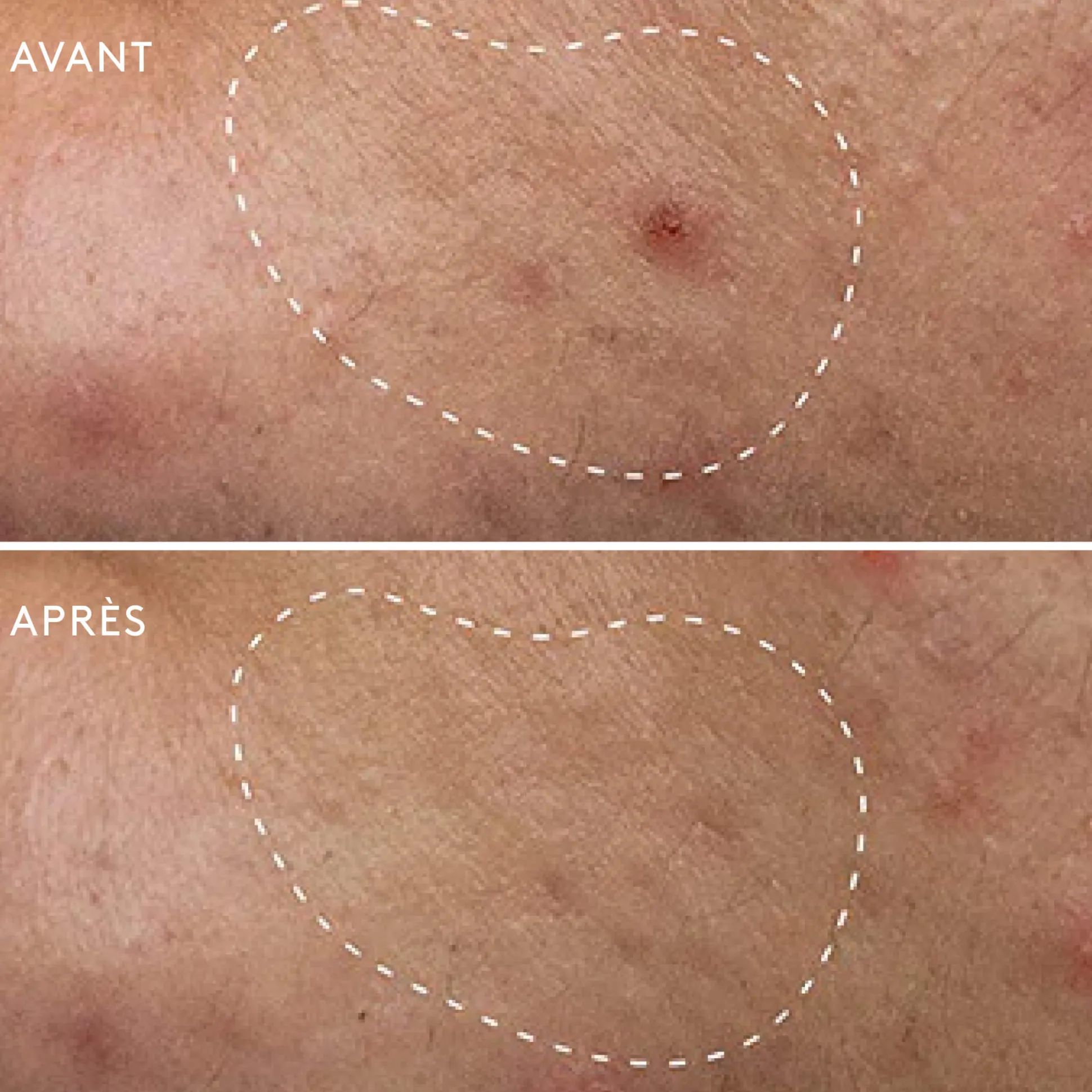 Deep Breakout Liquid Patch Anti-Imperfections